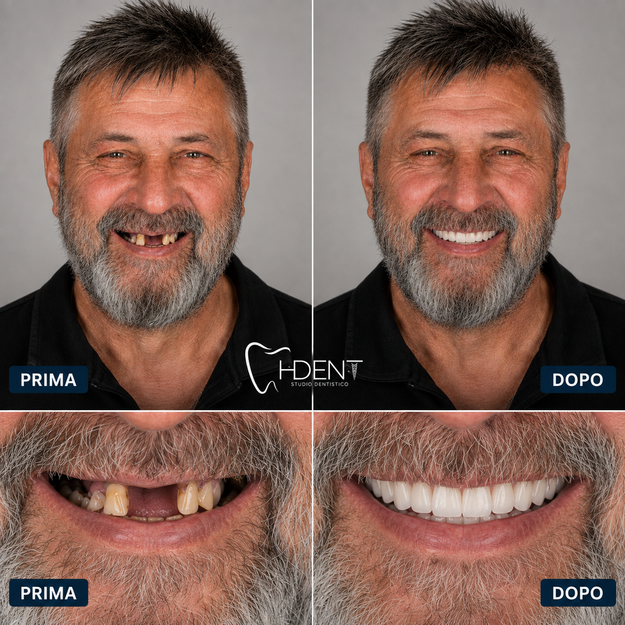 Risultato H-Dent prima e dopo, riabilitazione dentale completa